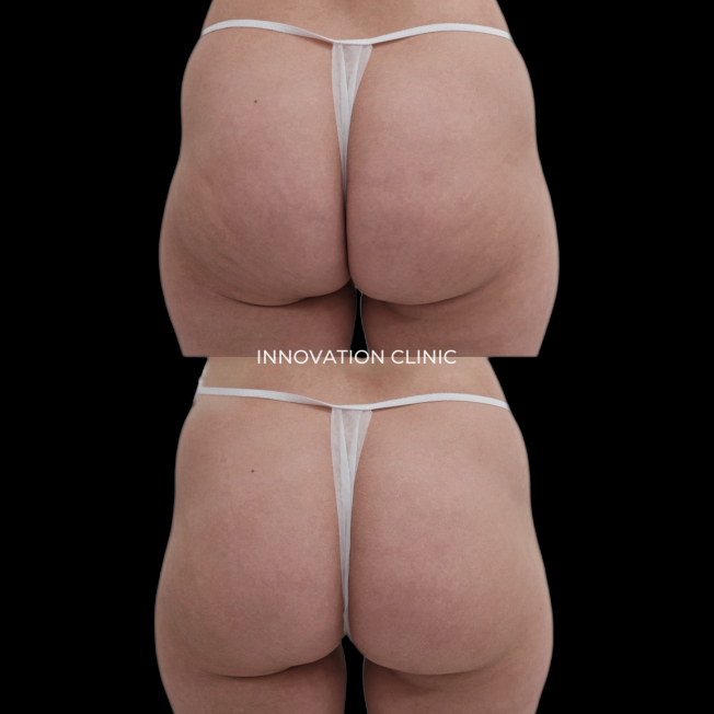 Монополярный RF-лифтинг Volnewmer фото до и после