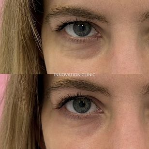 Филлер под глаза фото до и после