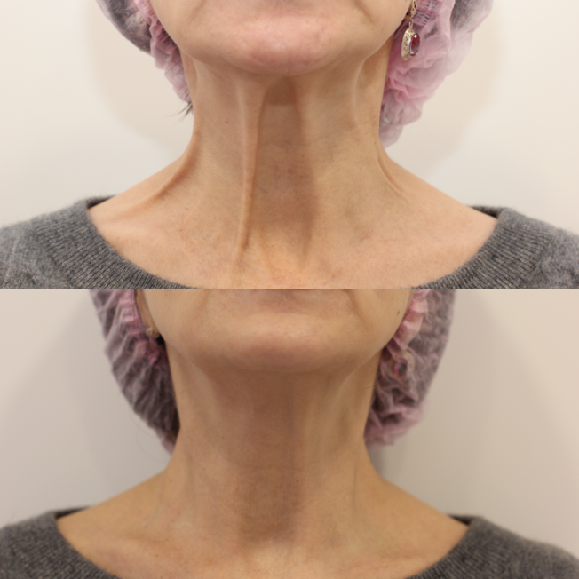 Устранение платизмарных тяжей фото до и после 1