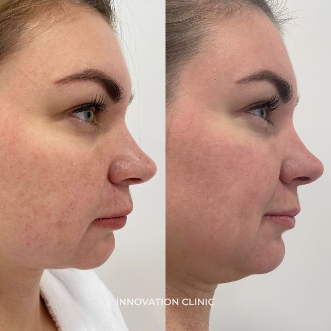 Лазерная шлифовка лица фото до и после 7