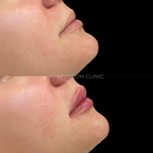 Коррекция формы губ филлером фото до и после 15