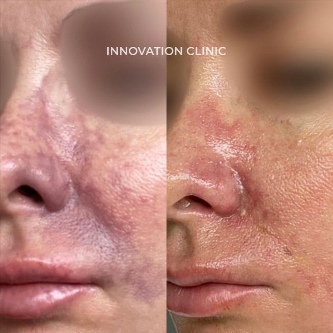 Лечение некроза кожи фото до и после 4