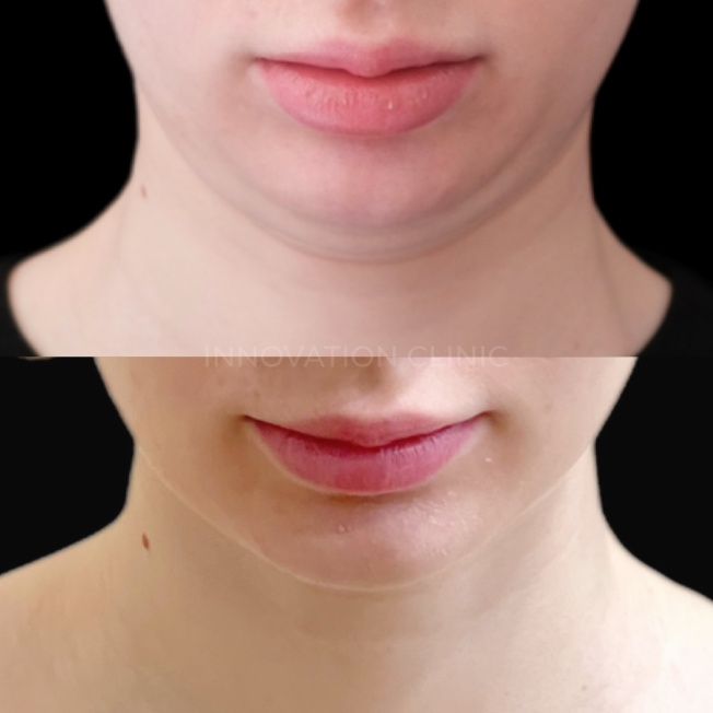 Малоинвазивный RF-лифтинг фото до и после 4