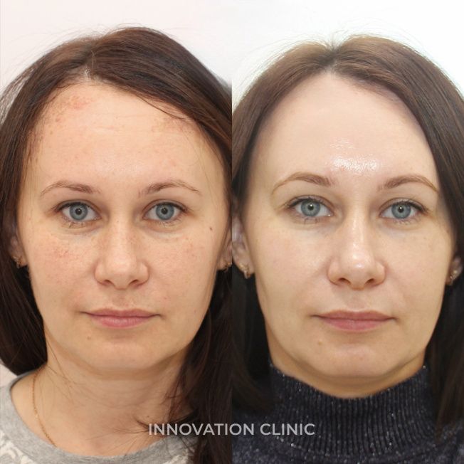 Сочетанный протокол фототерапия BBL фото до и после 1