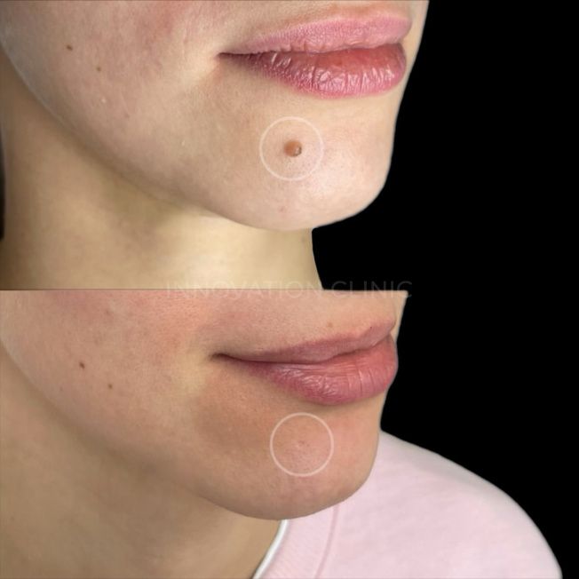 Удаление доброкачественного новообразования фото до и после 3