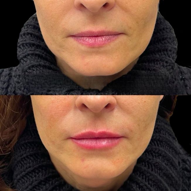 Коррекция формы губ филлером фото до и после 2