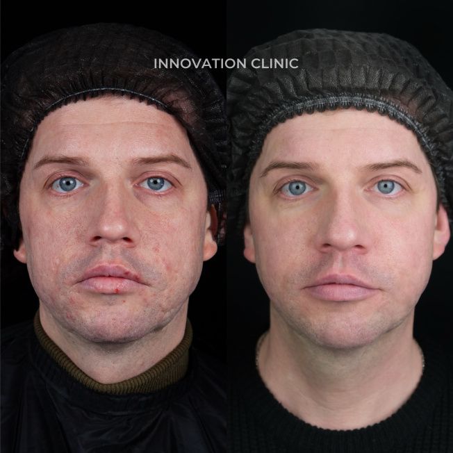 Комплексное лечение застарелых рубцов фото до и после