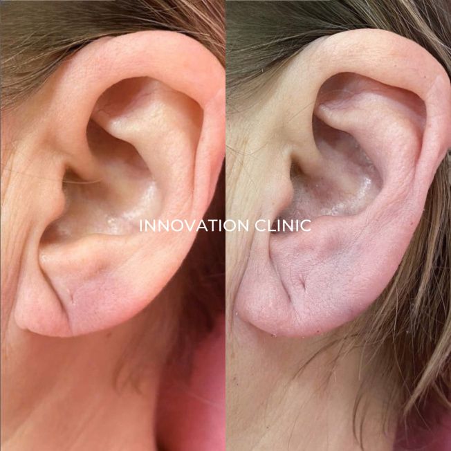 Коррекция мочки уха филлером фото до и после 4