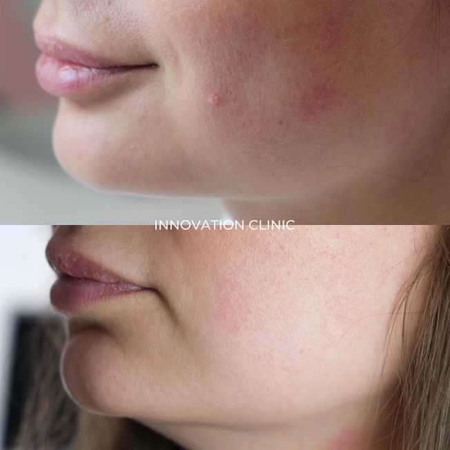 Удаление родинки фото до и после