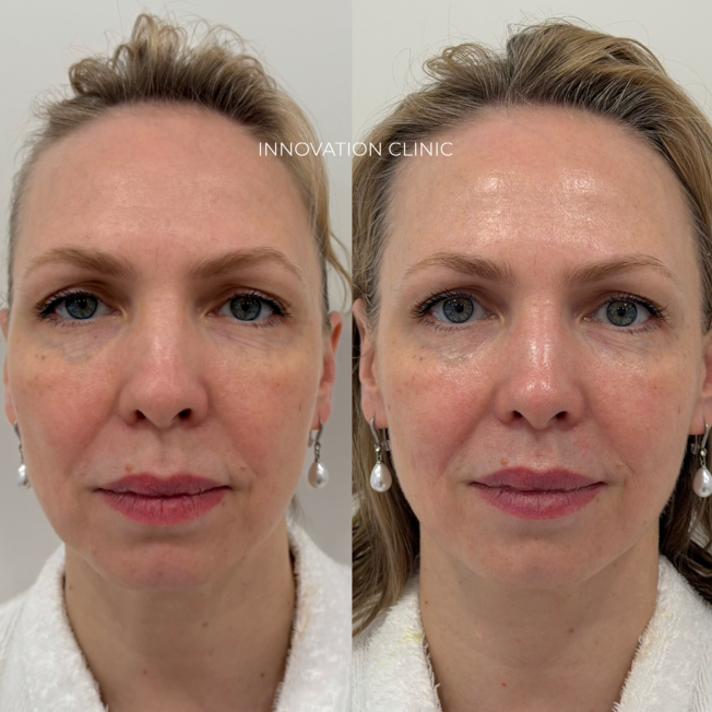 Улучшение качества кожи химическим пилингом Биорепил