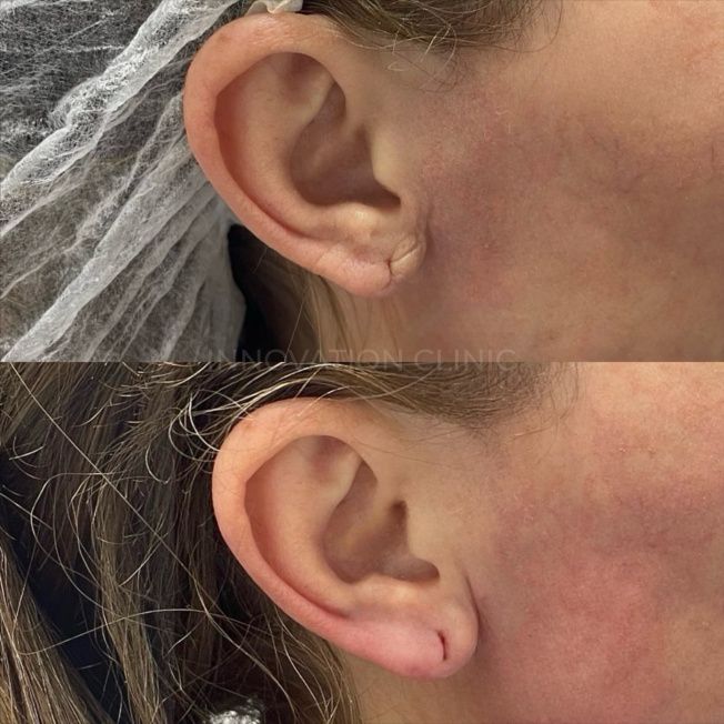 Коррекция мочки уха филлером фото до и после 3