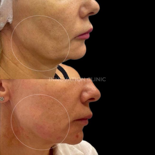 Нитевой лифтинг лица фото до и после 6