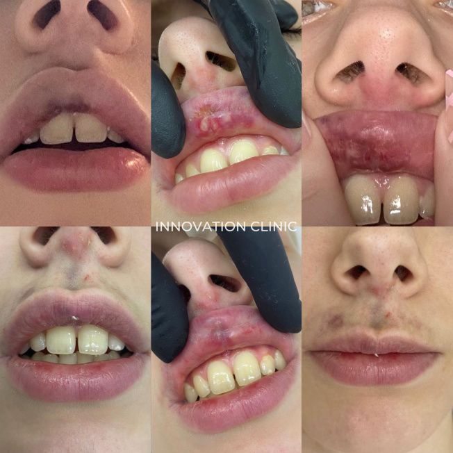 Лечение некроза мягких тканей фото до и после 2