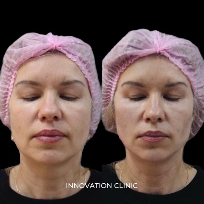 FullFace-коррекция лица филлерами фото до и после 5