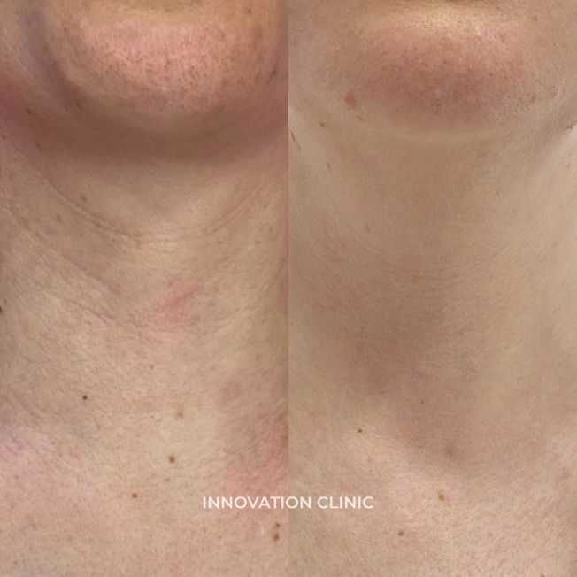 Коррекция "колец Венеры" фото до и после 1