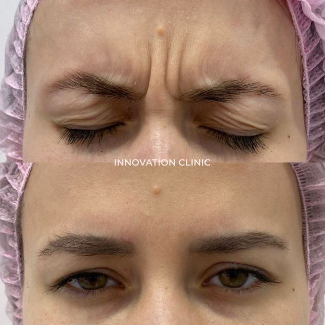 Коррекция мимических морщин межбровья фото до и после