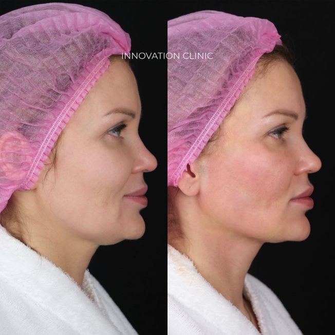 Подтяжка нитями нижней трети лица