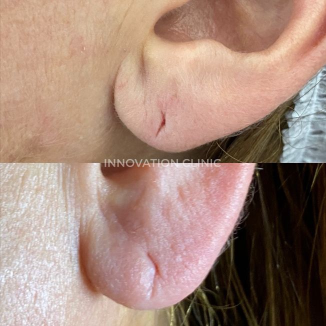 Коррекция мочки уха филлером фото до и после 2