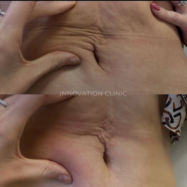 Армирование кожи живота фото до и после