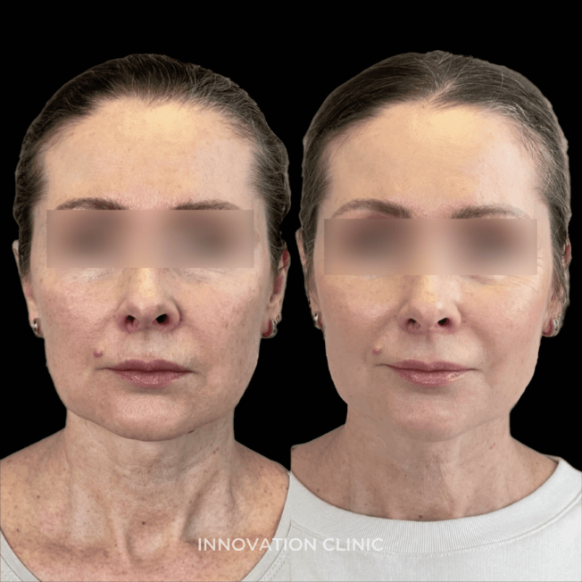 Нитевой лифтинг лица фото до и после 8
