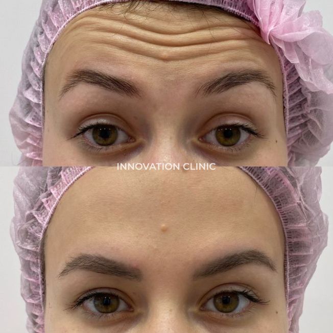 Коррекция мимических морщин лба фото до и после 6