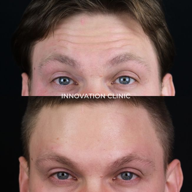 Коррекция мимических морщин лба фото до и после 10