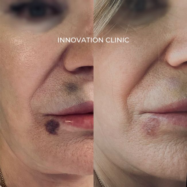 Ускорение схождения гематомы фото до и после 4