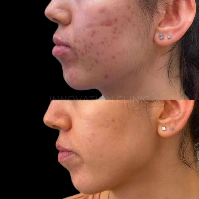 Комплексное лечение акне фото до и после 11