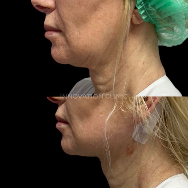 Нитевой лифтинг лица фото до и после 3