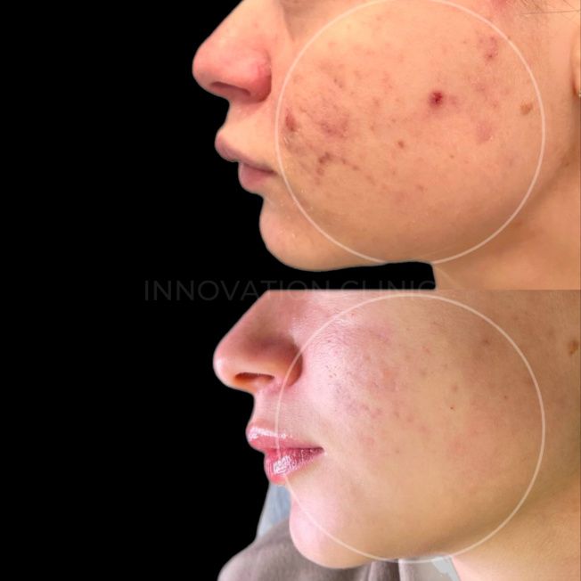 Комплексное лечение акне фото до и после 13