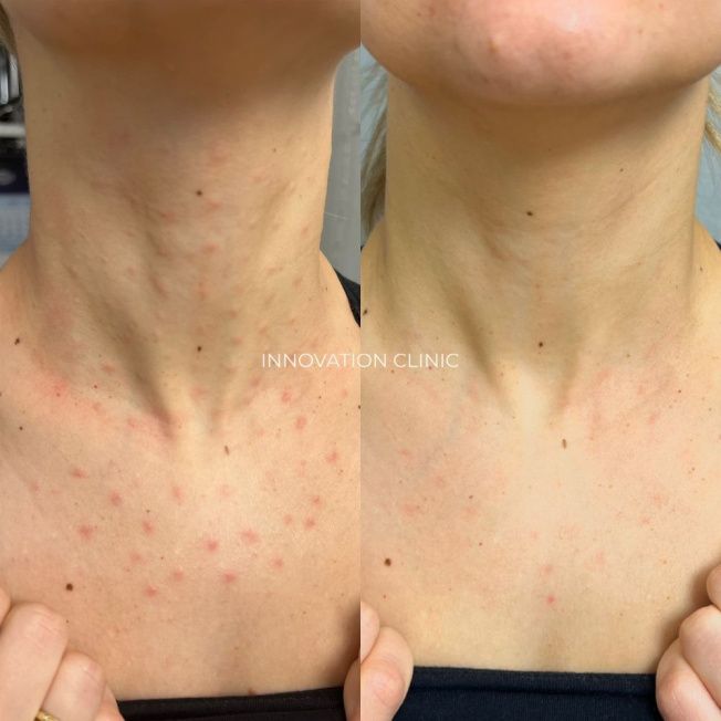 Лечение гранулемы инородного тела