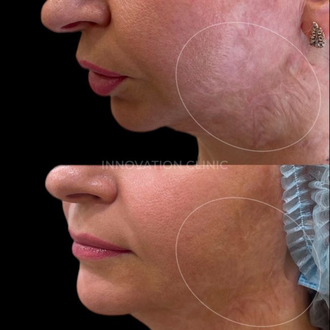 Лазерная шлифовка лица фото до и после 8