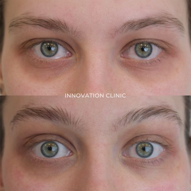 УЗ SMAS-лифтинг области вокруг глаз фото до и после