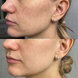 Лечение гранулемы инородного тела