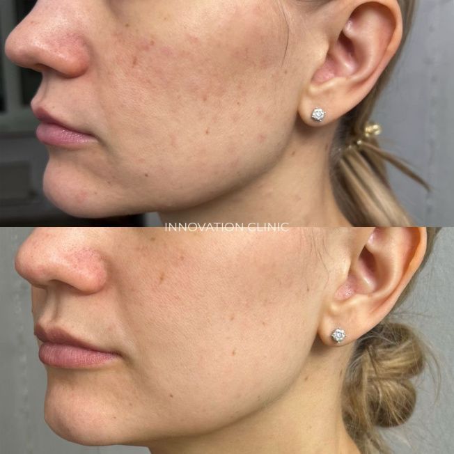 Лечение гранулемы инородного тела