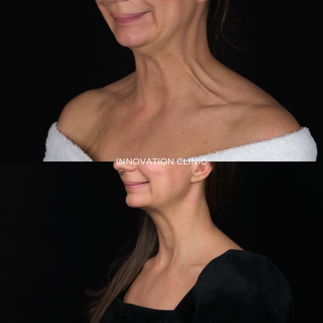 Устранение платизмарных тяжей фото до и спустя 14 дней