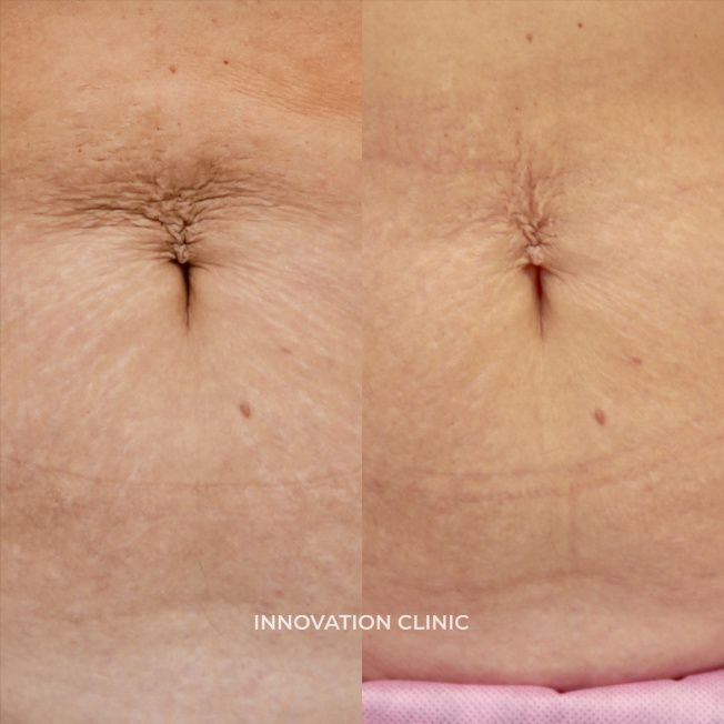 Микроигольчатый RF-лифтинг живота фото до и после 2