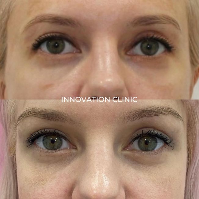 Коррекция формы верхнего века фото до и после 1