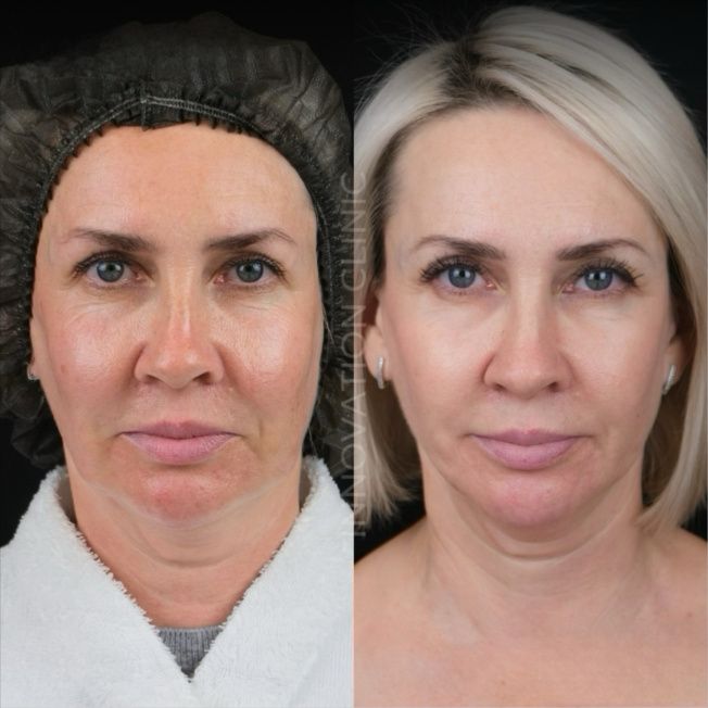 Монополярный RF-лифтинг Volnewmer фото до и после 4