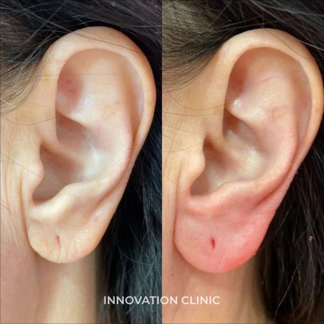 Коррекция мочки уха филлером фото до и после 1