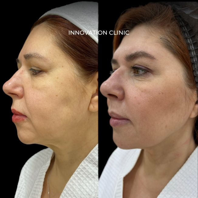 результат после протокола микроигольчатого RF-лифтинга и Smas - лифтинга