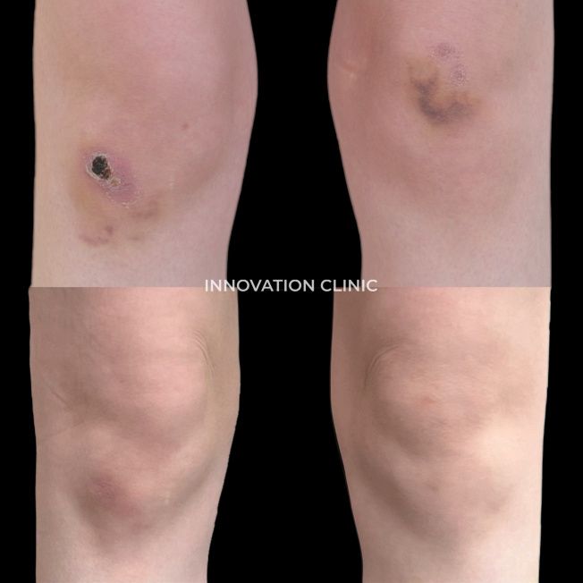 Ускорение схождения гематомы фото до и после 2