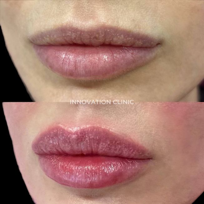 Коррекция формы губ филлером фото до и после 24