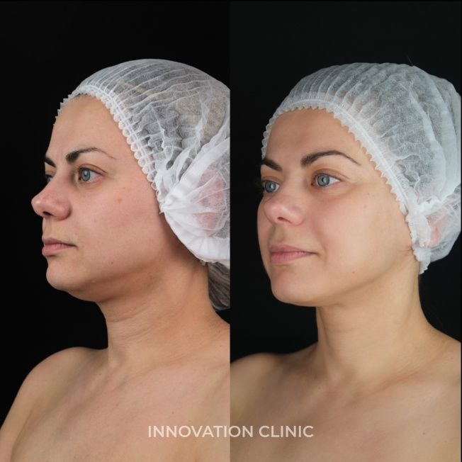 Процедура VOLFORMER фото до и после 2