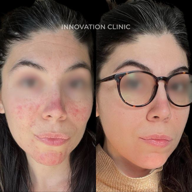 Комплексное лечение акне фото до и после 18