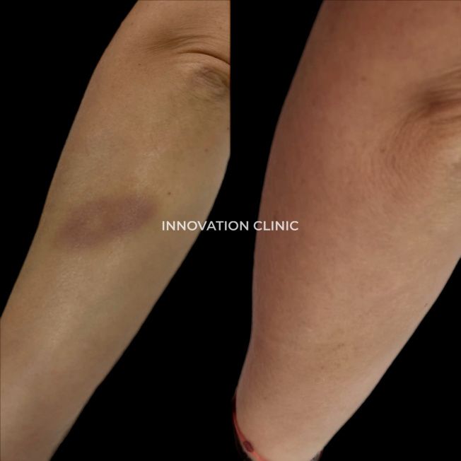 Ускорение схождения гематомы фото до и после 3