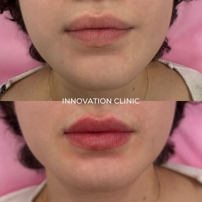 Коррекция формы губ филлером фото до и после 25