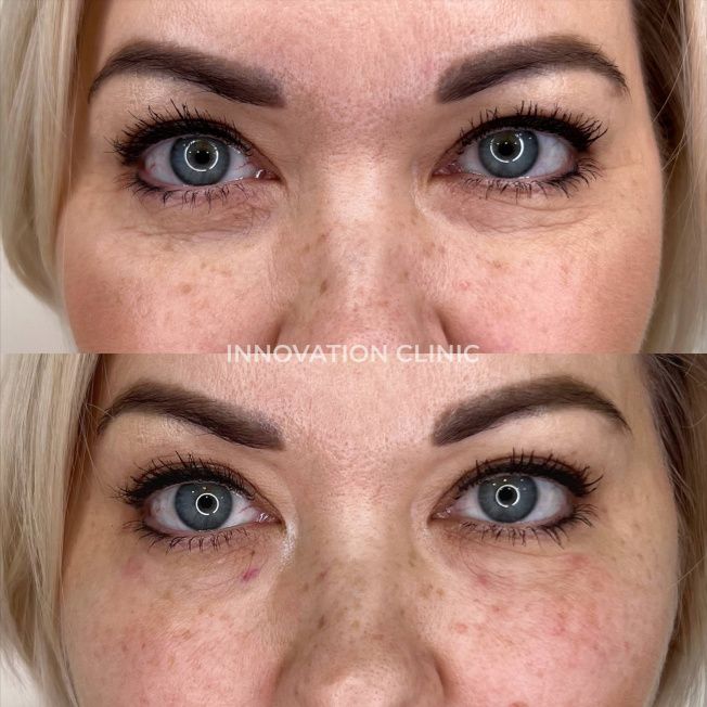 Коррекция носослёзной борозды фото до и после 9