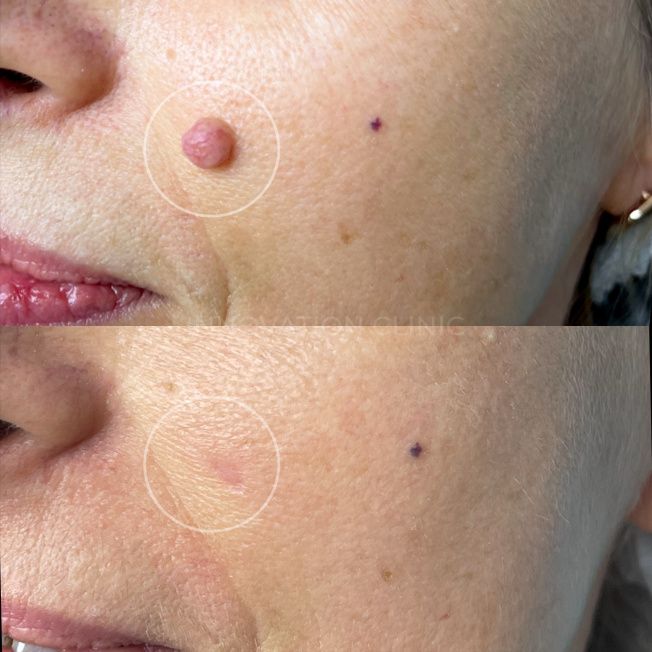 Удаление доброкачественного новообразования фото до и после 1