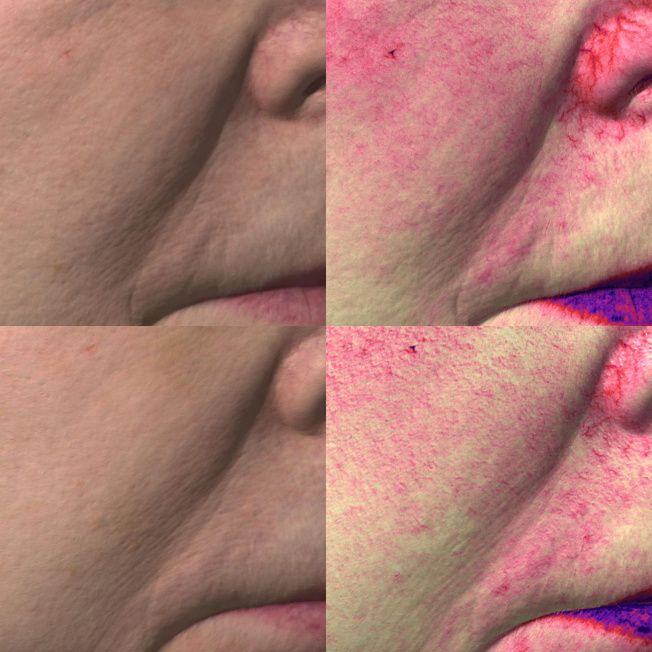 Биореструктуризация препаратом ARES Anti Oxidant фото до и после 2